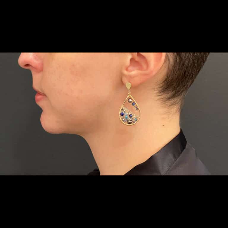 After Image: Case #8451 – Chin Implant - left-side