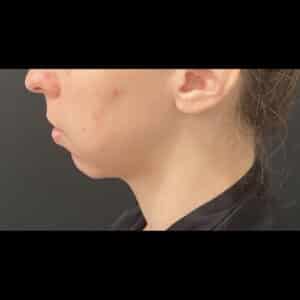 Before Image: Case #8451 – Chin Implant