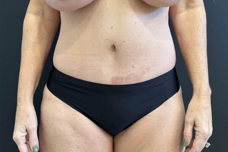 After Image: Case #8454 – SAFElipo of Circ Trunk, Excess Skin Removal - front