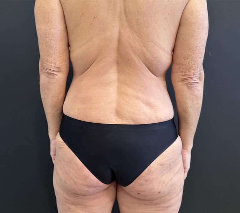 After Image: Case #8454 – SAFElipo of Circ Trunk, Excess Skin Removal - back