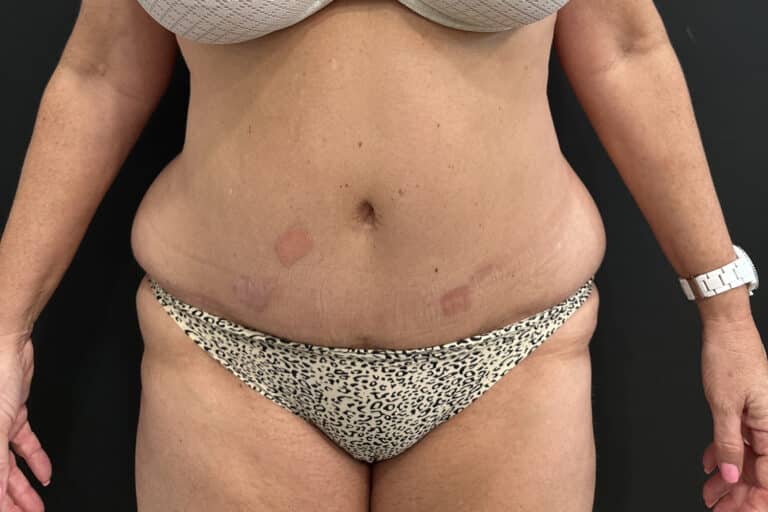 Before Image: Case #8454 – SAFElipo of Circ Trunk, Excess Skin Removal - front