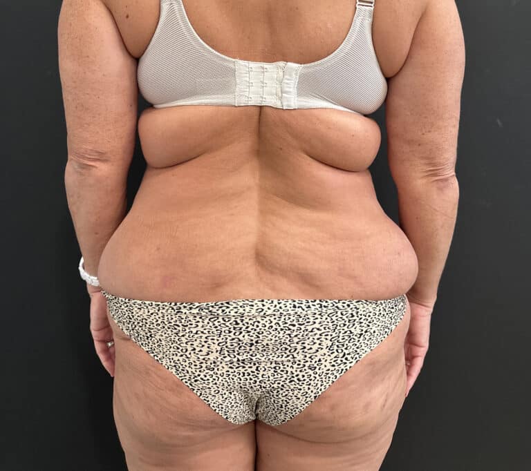 Before Image: Case #8454 – SAFElipo of Circ Trunk, Excess Skin Removal - back