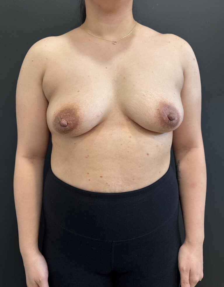Before Image: Case #8469 –  Breast Augmentation - front