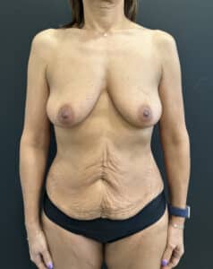Before Image: Case #8554 – Abdominoplasty with safelipo sculpting of trunk, breast augmentation with lift