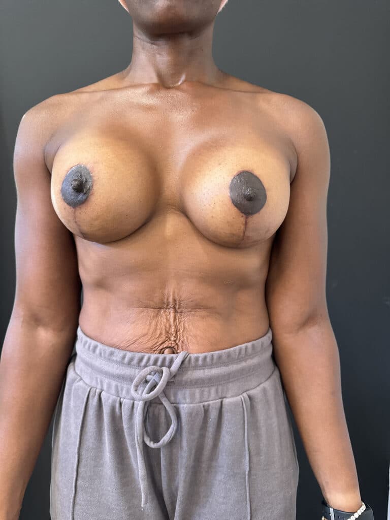 After Image: Case #8592 – Ethnic, Breast Lift with Augmentation - front