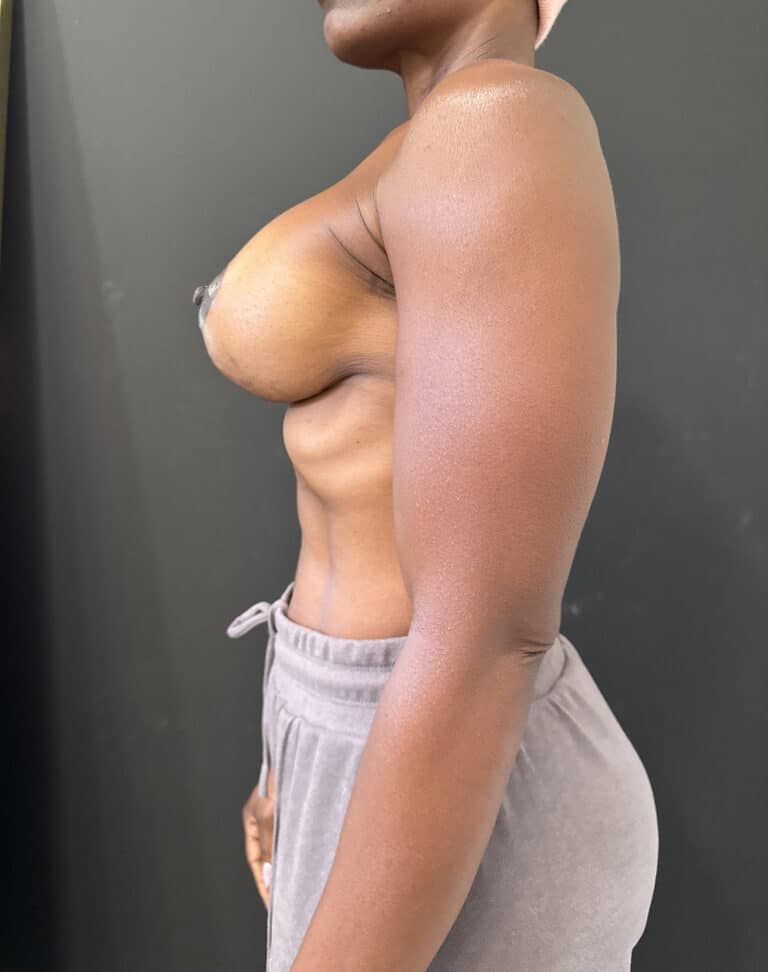 After Image: Case #8592 – Ethnic, Breast Lift with Augmentation - left-side