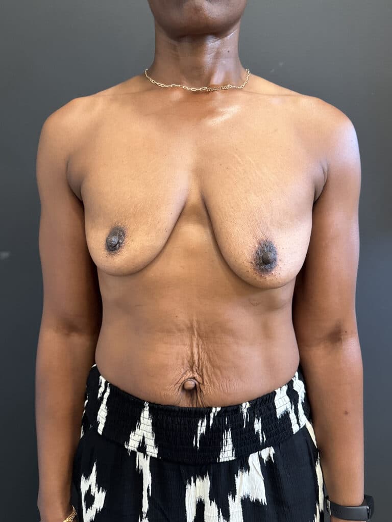 Before Image: Case #8592 – Ethnic, Breast Lift with Augmentation - front