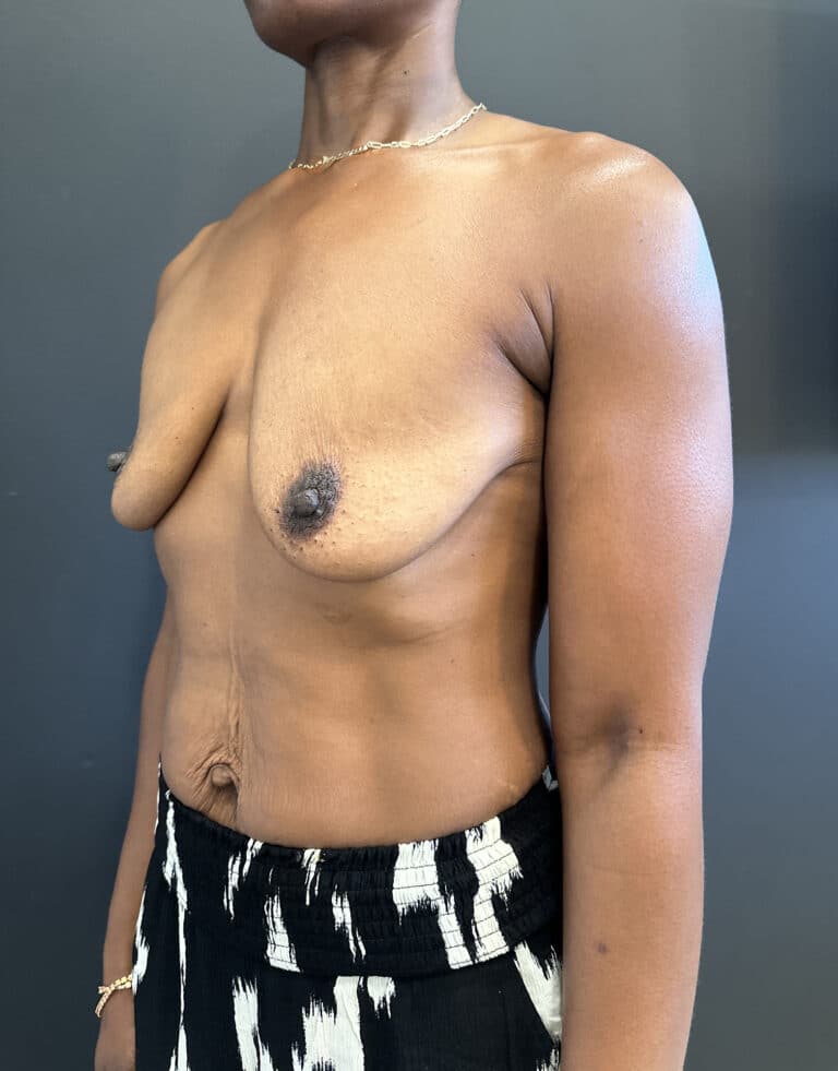 Before Image: Case #8592 – Ethnic, Breast Lift with Augmentation - left-front-oblique