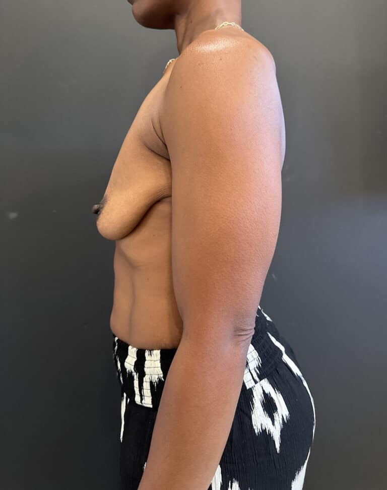 Before Image: Case #8592 – Ethnic, Breast Lift with Augmentation - left-side