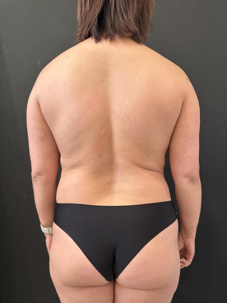 After Image: Mommy Makeover - back