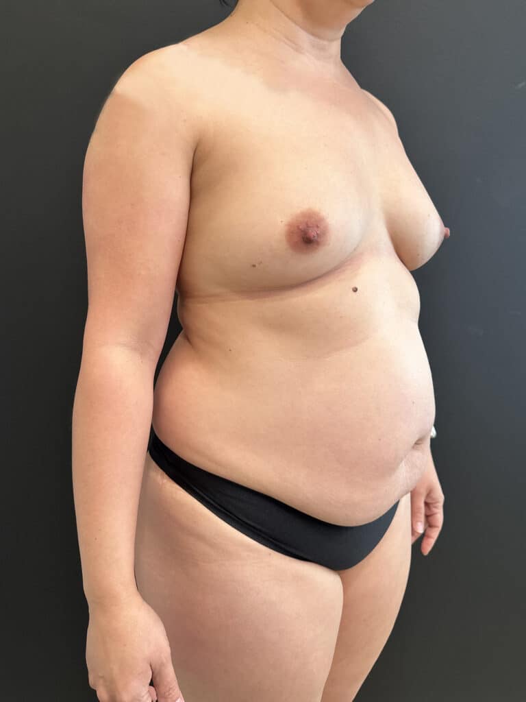 Before Image: Mommy Makeover - right-front-oblique