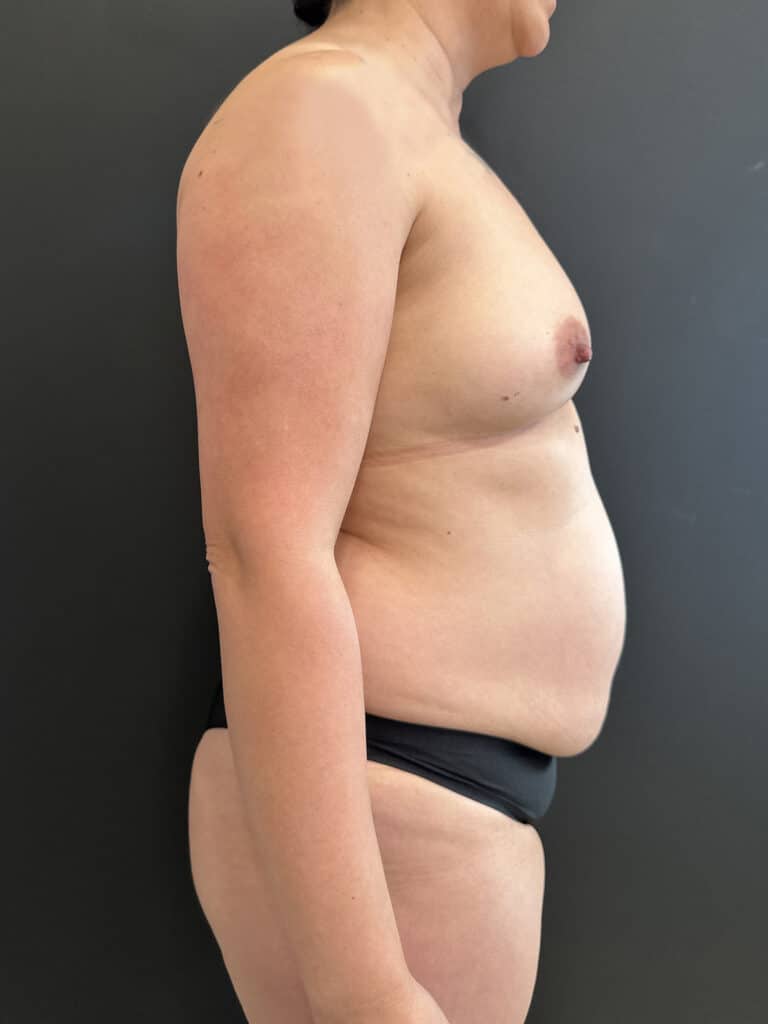 Before Image: Mommy Makeover - right-side