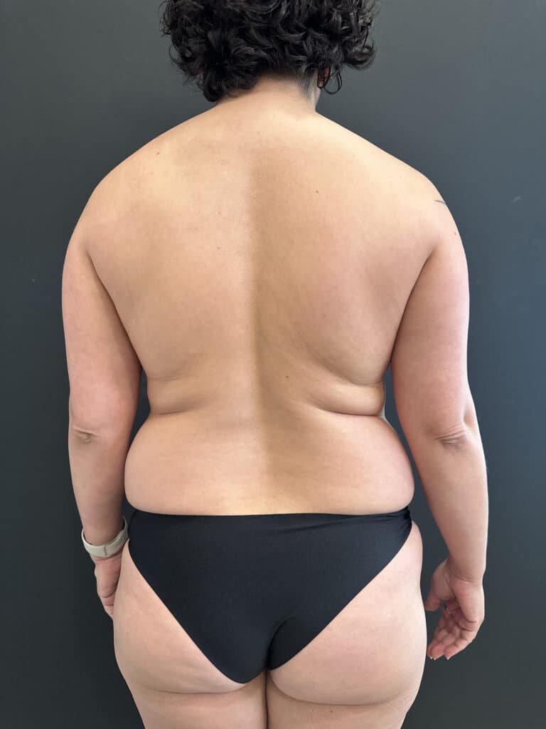 Before Image: Mommy Makeover - back