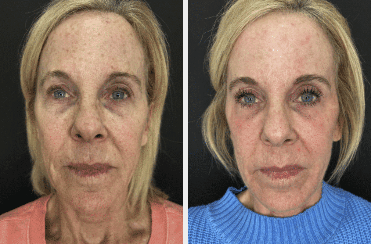 Before and After Image of Fractional Co2 Laser Resurfacing Dallas TX