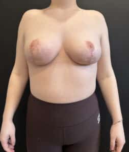 After Image: Case #9238 – Breast Reduction