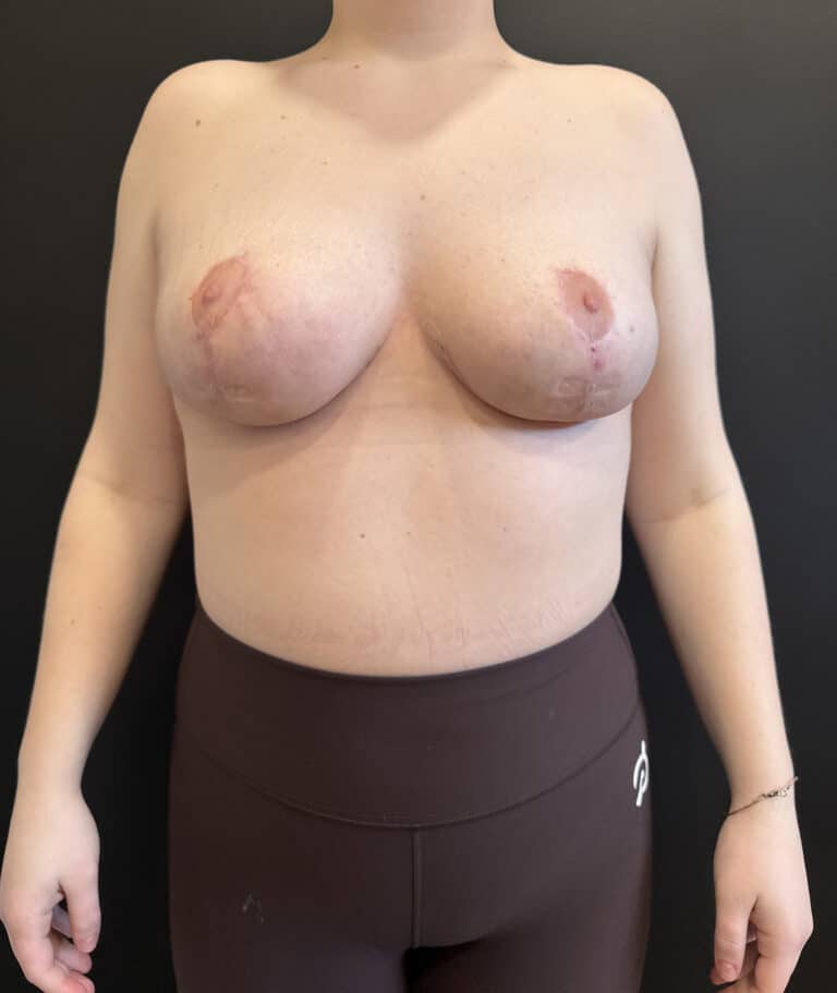 After Image: Case #9238 – Breast Reduction - front