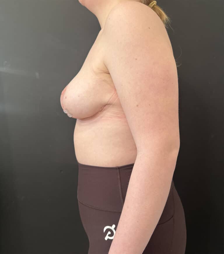 After Image: Case #9238 – Breast Reduction - left-side