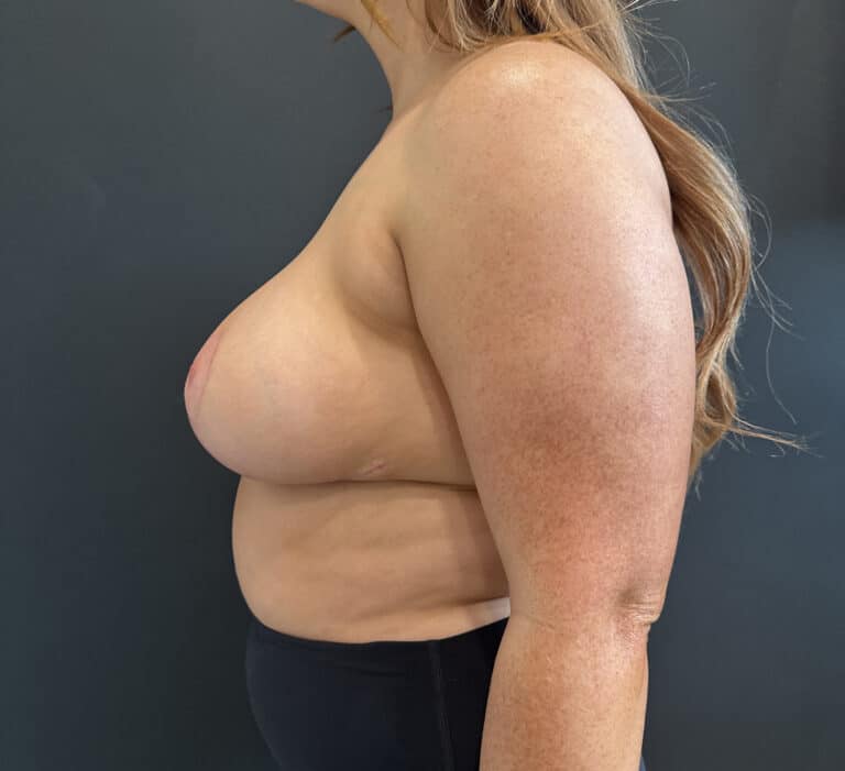After Image: Case #9256 – Breast Reduction - left-side
