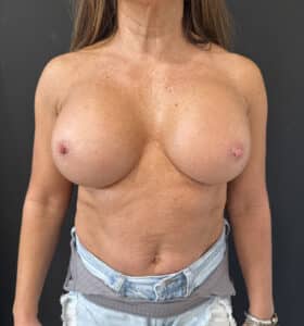 After Image: Case #9261 – Breast Implant Exchange