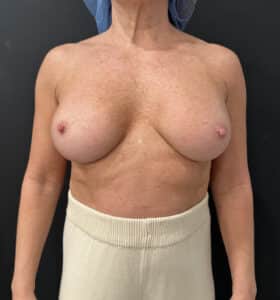 Before Image: Case #9261 – Breast Implant Exchange