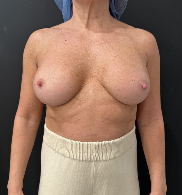Before Image: Case #9261 – Breast Implant Exchange - front
