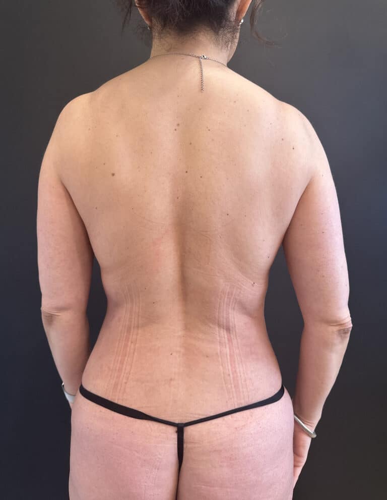 After Image: Case #9293 – Breast Implant Exchange, SAFELipo, and Breast Augmentation with Lift - back