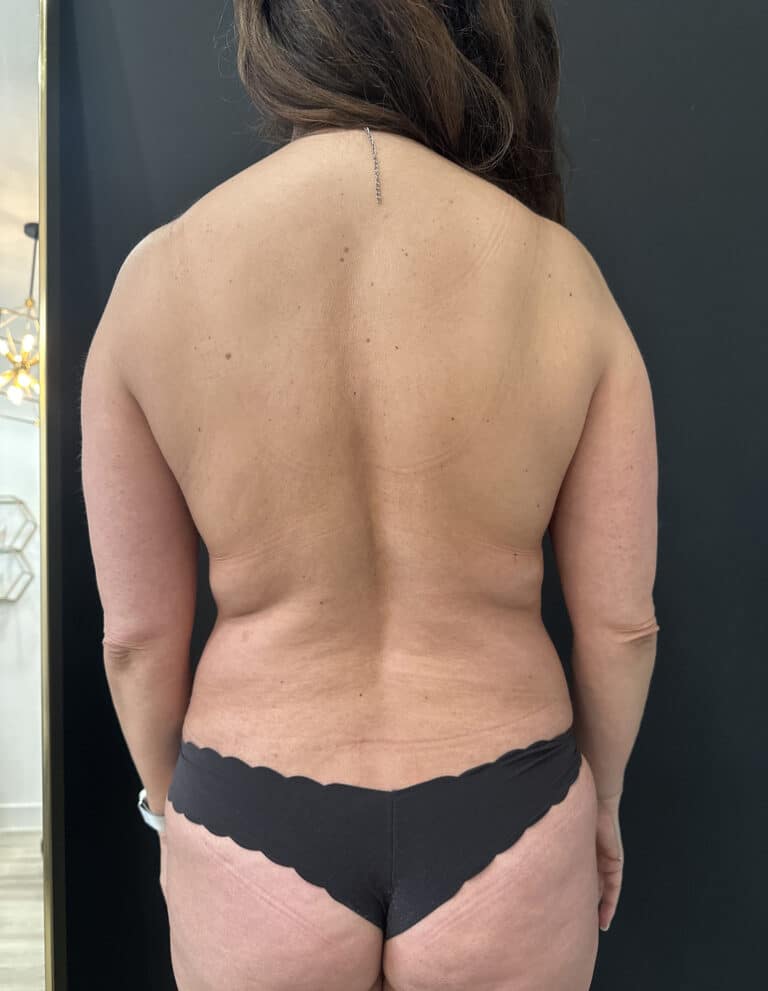 Before Image: Case #9293 – Breast Implant Exchange, SAFELipo, and Breast Augmentation with Lift - back