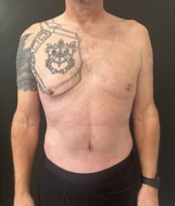 After Image: Case #9304 – Male Tummy Tuck