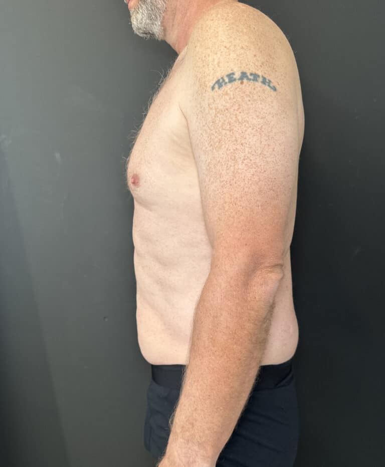 After Image: Case #9304 – Male Tummy Tuck - left-side