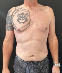 Before Image: Case #9304 – Male Tummy Tuck