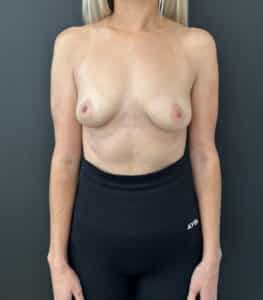 Before Image: Case #9309 – Breast Augmentation