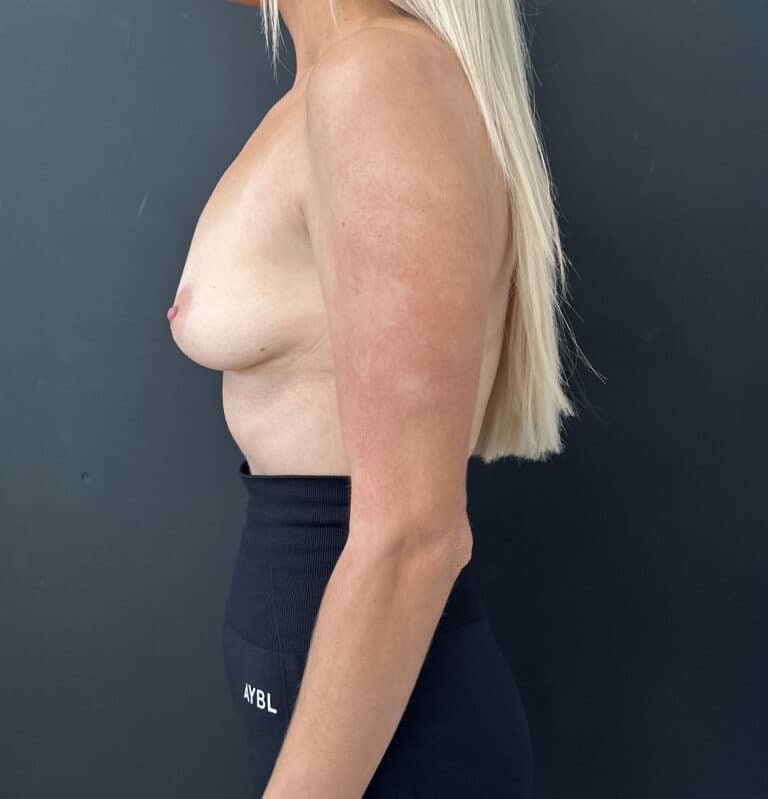 Before Image: Case #9309 – Breast Augmentation - left-side