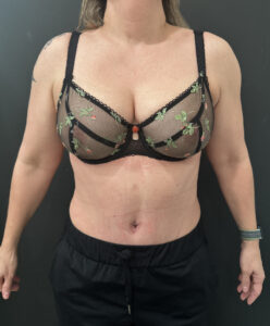 After Image: Case #9330 – Abdominoplasty, Safelipo of Circ Trunk
