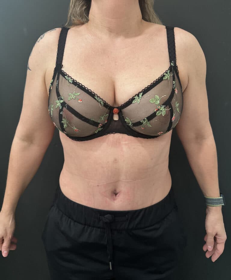 After Image: Case #9330 – Abdominoplasty, Safelipo of Circ Trunk - front