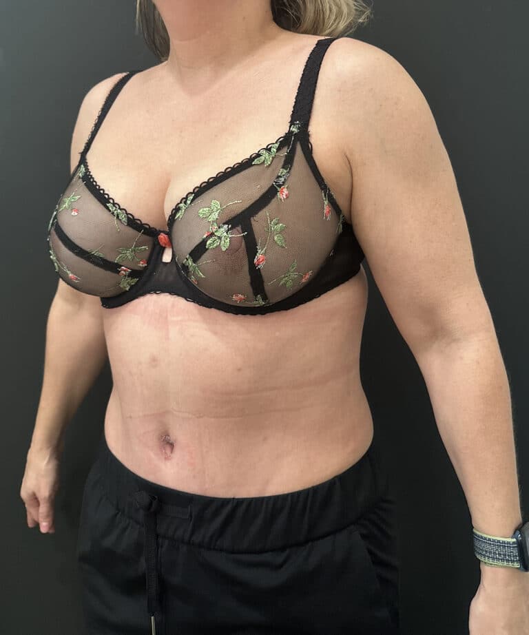 After Image: Case #9330 – Abdominoplasty, Safelipo of Circ Trunk - left-front-oblique