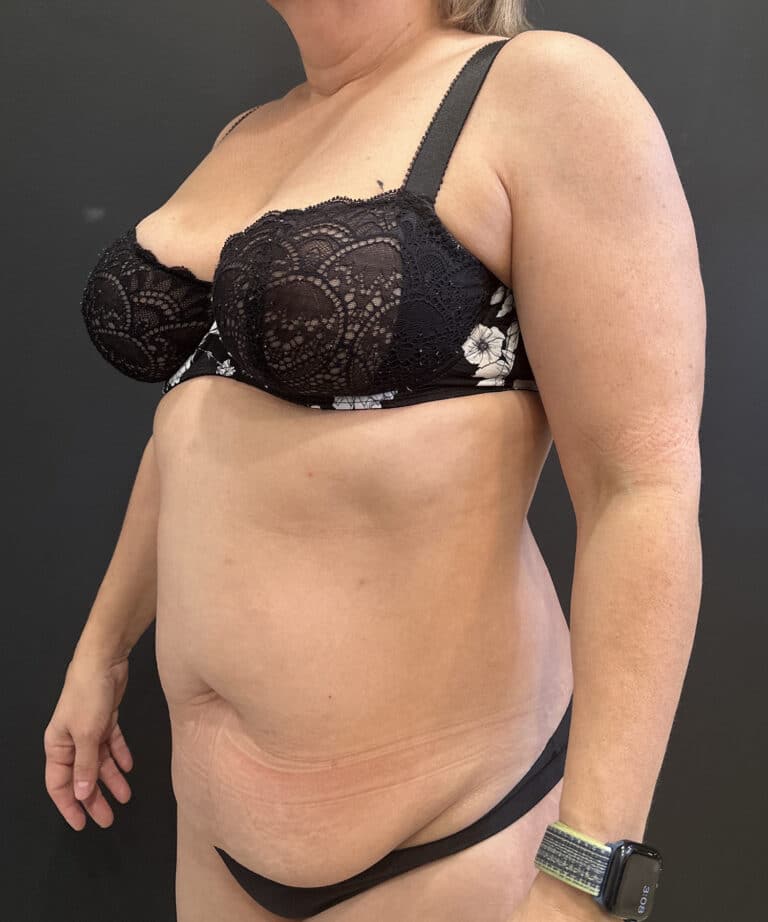 Before Image: Case #9330 – Abdominoplasty, Safelipo of Circ Trunk - left-front-oblique