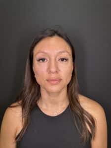 After Image: Case #9356 – Cheek Filler by Katelyn Gross, BSN RN