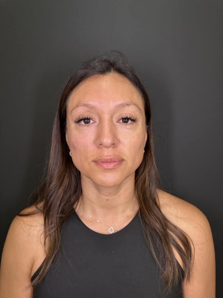 After Image: Case #9356 – Cheek Filler by Katelyn Gross, BSN RN - front