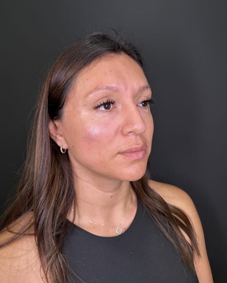 After Image: Case #9356 – Cheek Filler by Katelyn Gross, BSN RN - right-front-oblique