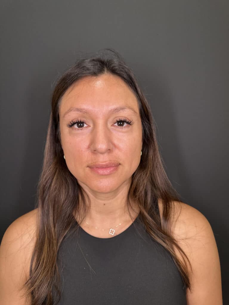 Before Image: Case #9356 – Cheek Filler by Katelyn Gross, BSN RN - front
