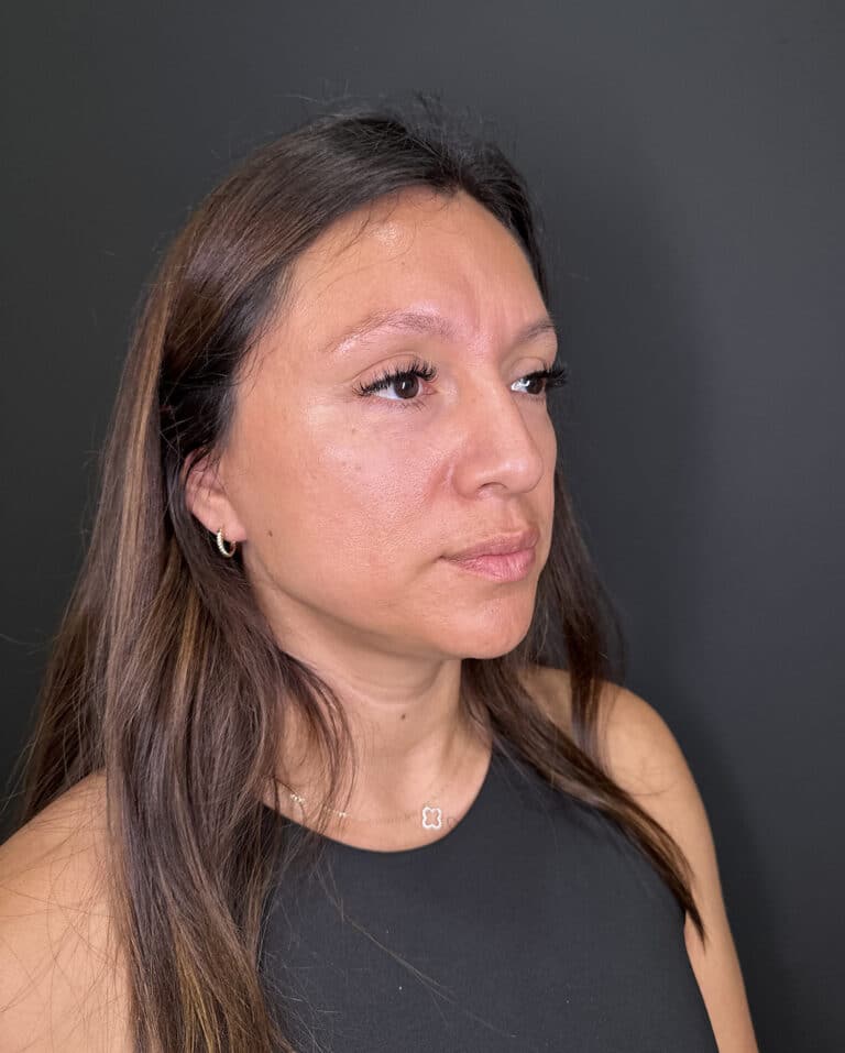 Before Image: Case #9356 – Cheek Filler by Katelyn Gross, BSN RN - right-front-oblique