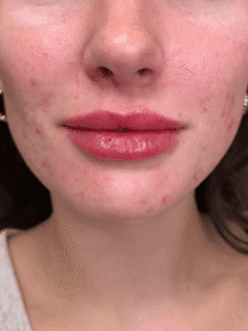 After Image: Case #9362 – Lip Filler by Katelyn Gross, BSN RN