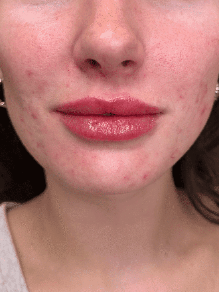After Image: Case #9362 – Lip Filler by Katelyn Gross, BSN RN - front