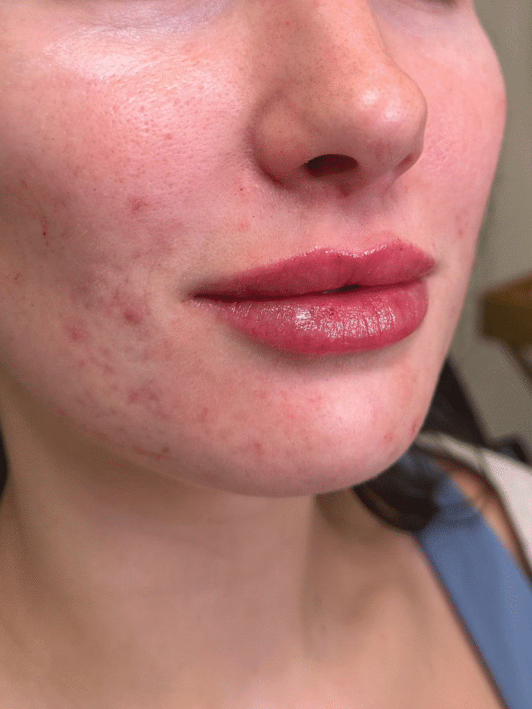 After Image: Case #9362 – Lip Filler by Katelyn Gross, BSN RN - right-front-oblique