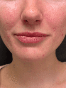 Before Image: Case #9362 – Lip Filler by Katelyn Gross, BSN RN