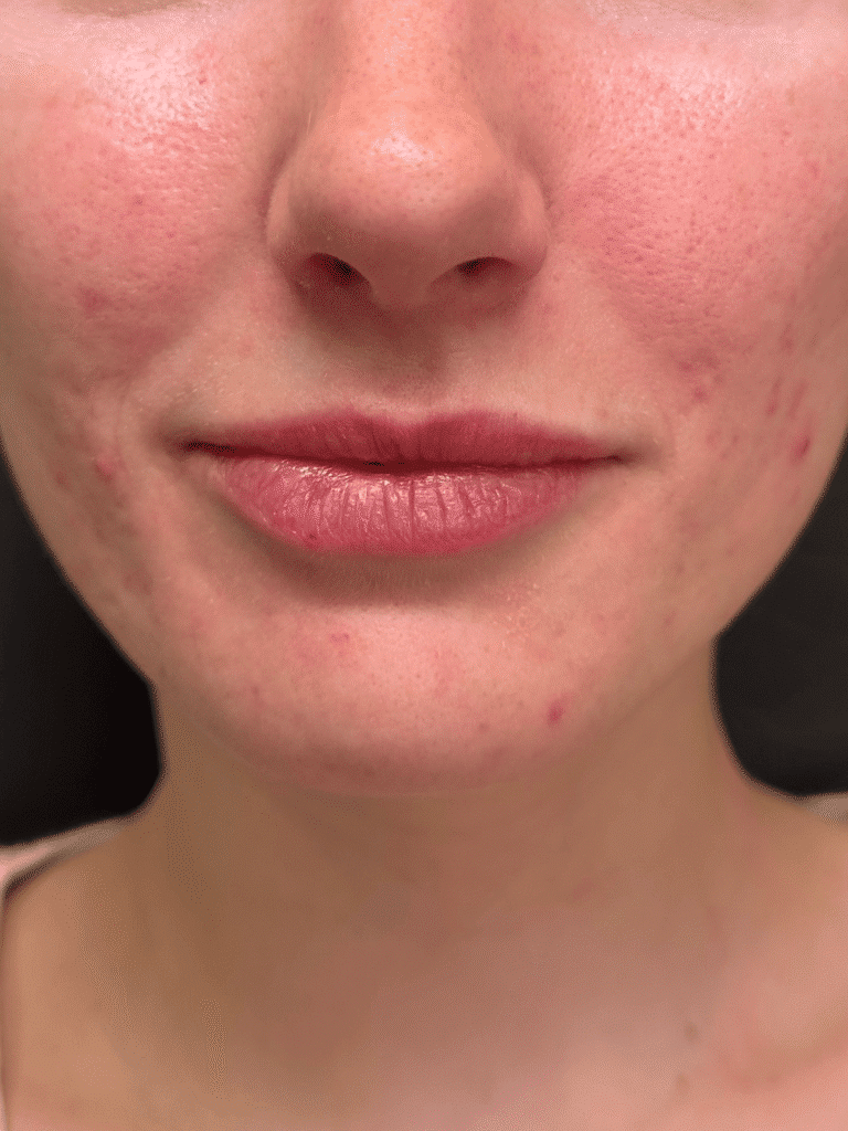 Before Image: Case #9362 – Lip Filler by Katelyn Gross, BSN RN - front