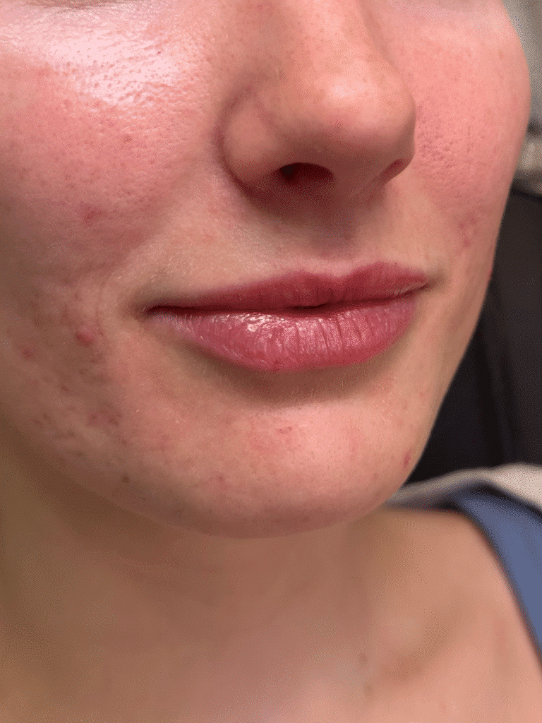 Before Image: Case #9362 – Lip Filler by Katelyn Gross, BSN RN - right-front-oblique