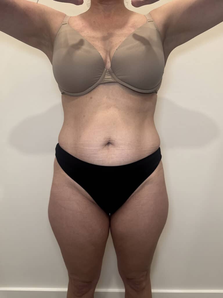 After Image: Case #9373 – Emsculpt Neo - front