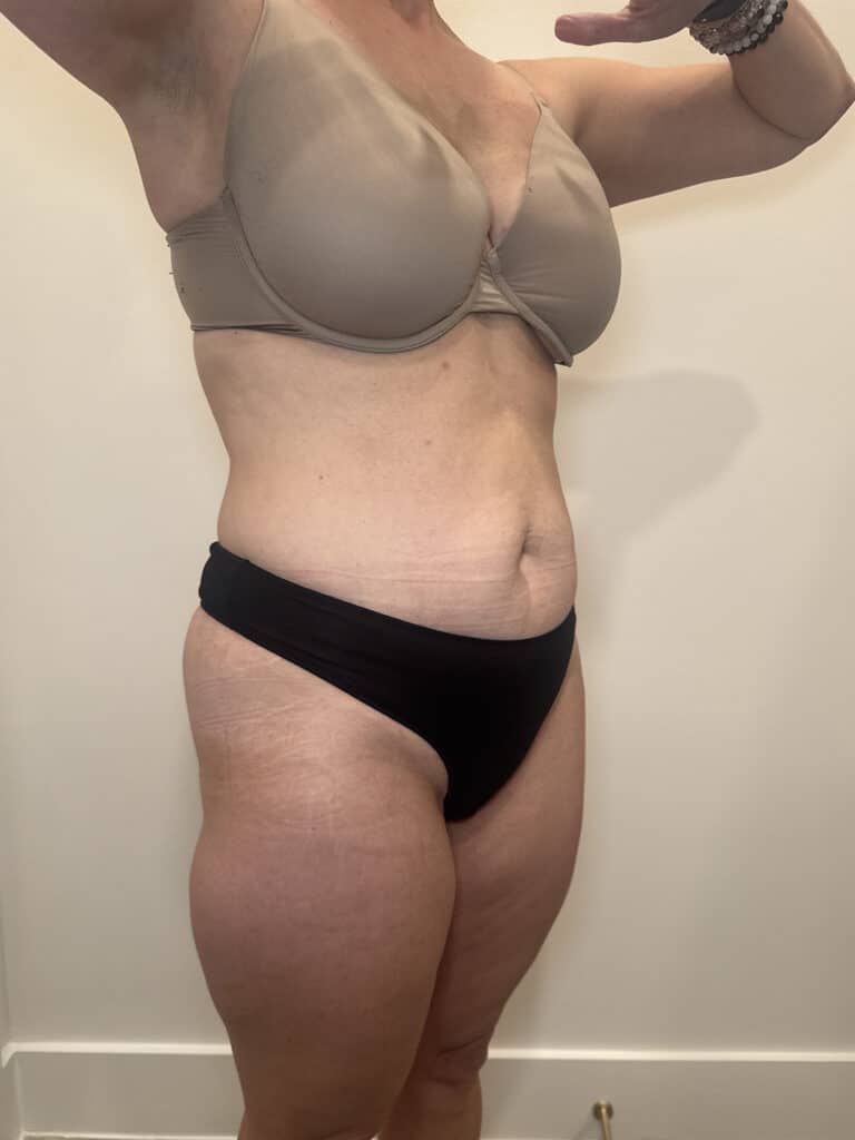 After Image: Case #9373 – Emsculpt Neo - right-front-oblique