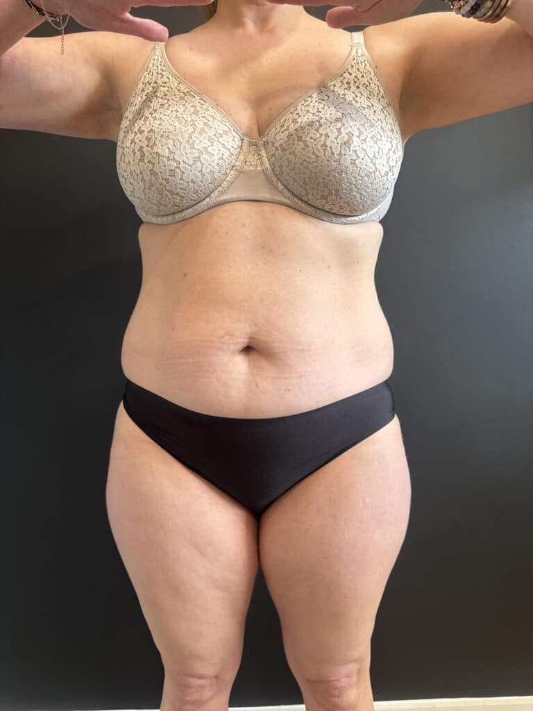 Before Image: Case #9373 – Emsculpt Neo - front